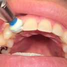 歯の研磨